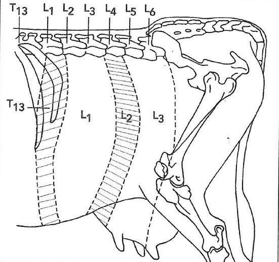 Figure 17 Régions du flanc anesthésiées après une anesthésie paravertébrale proximale ou distale