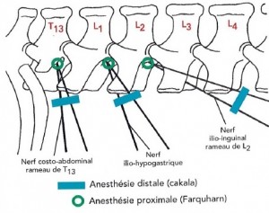 Figure 21 Vue latérale de l'injection d'anesthésique en paravertébral