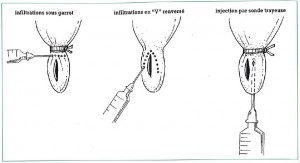 anesth locale des trayons- GTV 9 p8 bouisset